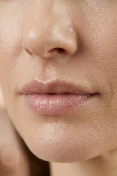 Preenchimento com acido hialuronico plena face